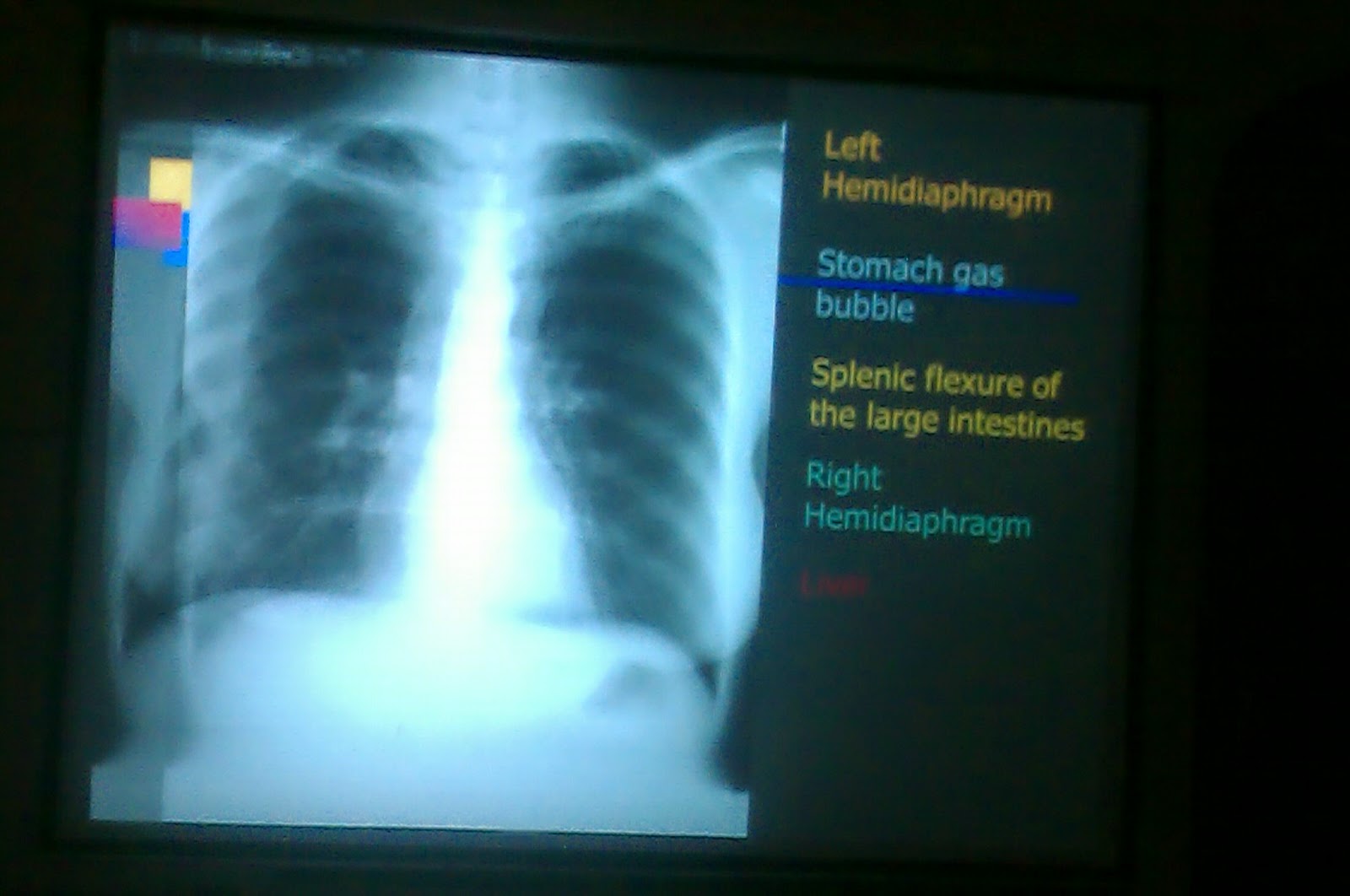 Lecture slides Radiology Chest X ray