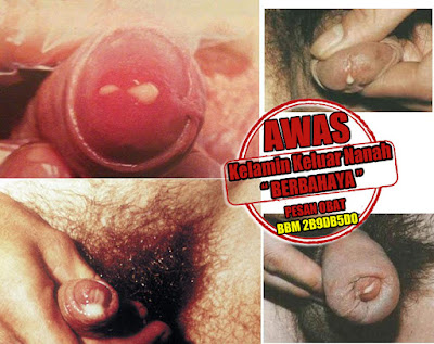 Ramuan Herbal Untuk Mengatasi Kencing Nanah Ramuan Herbal Untuk Mengatasi Kencing Nanah
