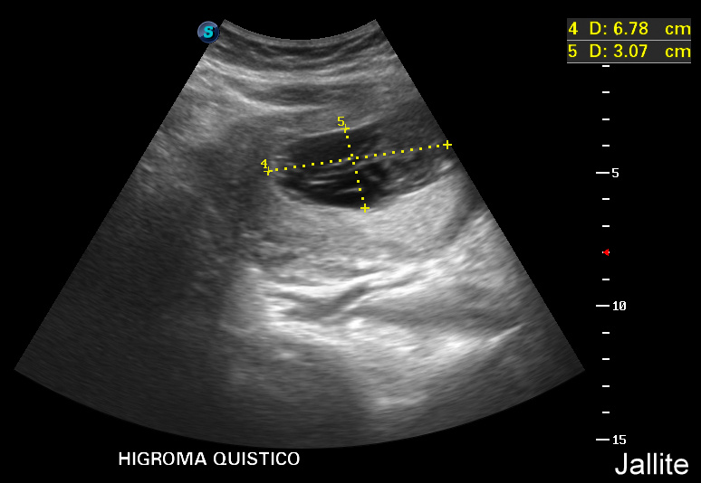 Higroma Quistico & Oligohidramnios & Obito