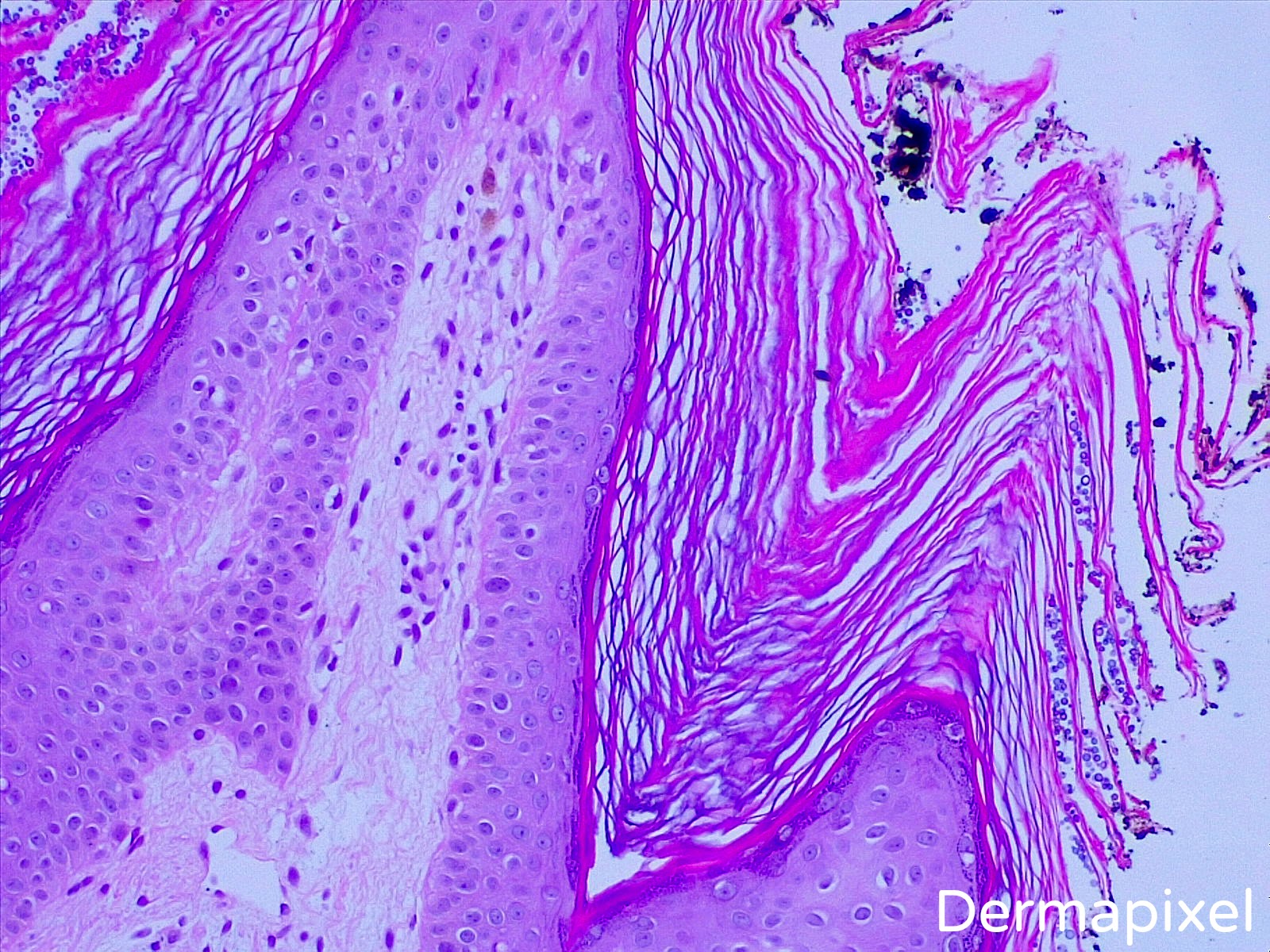 Papillomatosis dermatology. ChSkin (1) - Papillomatosis in skin tags