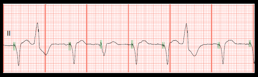 EKG Rhythm Quiz 242