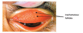sago grains follicles trachoma signs