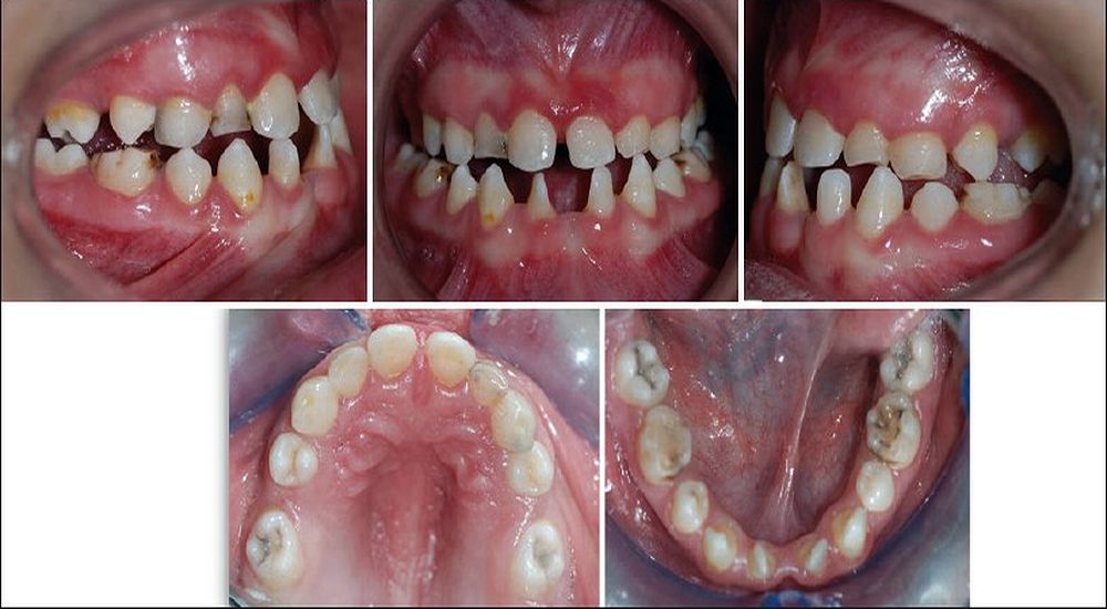 ORTHODONTIC Malocclusion in Down syndrome a review odontobebe