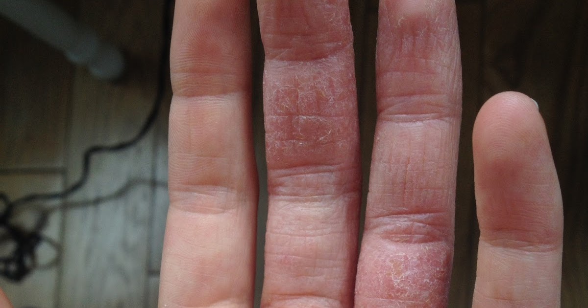 The Itchiest Itch Seeking a cure for Dyshidrotic Eczema Dr Aron