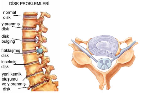 bel fitigi ameliyati ve yasadiklarim