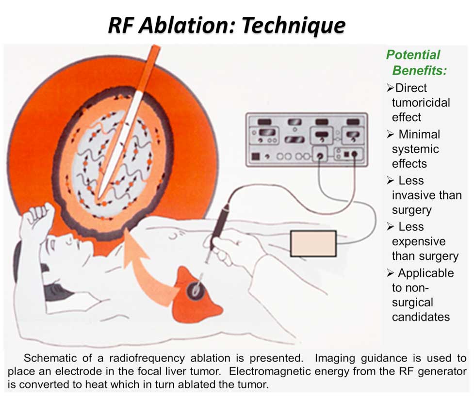 EXAMS AND ME Radiofrequency Ablation exams-and-me-radiofrequency-ablation