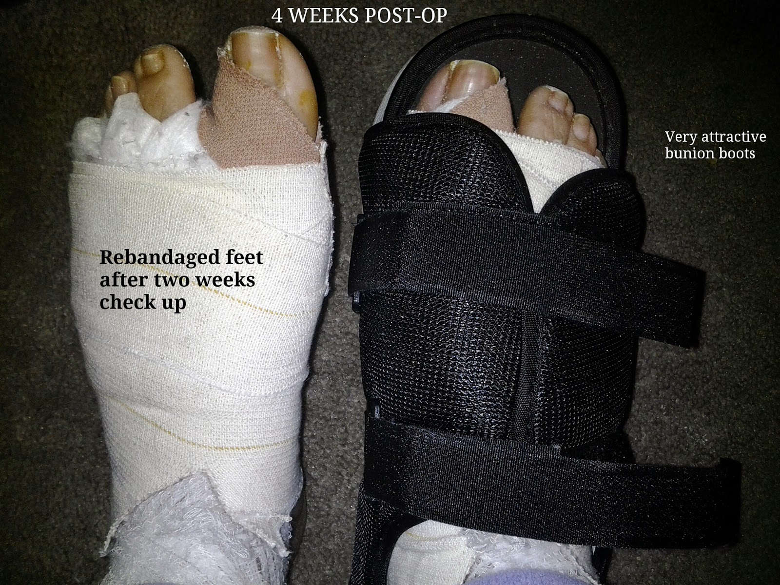 LatestAdventuresofMonicaandCarl MONICA'S BUNION SURGERY