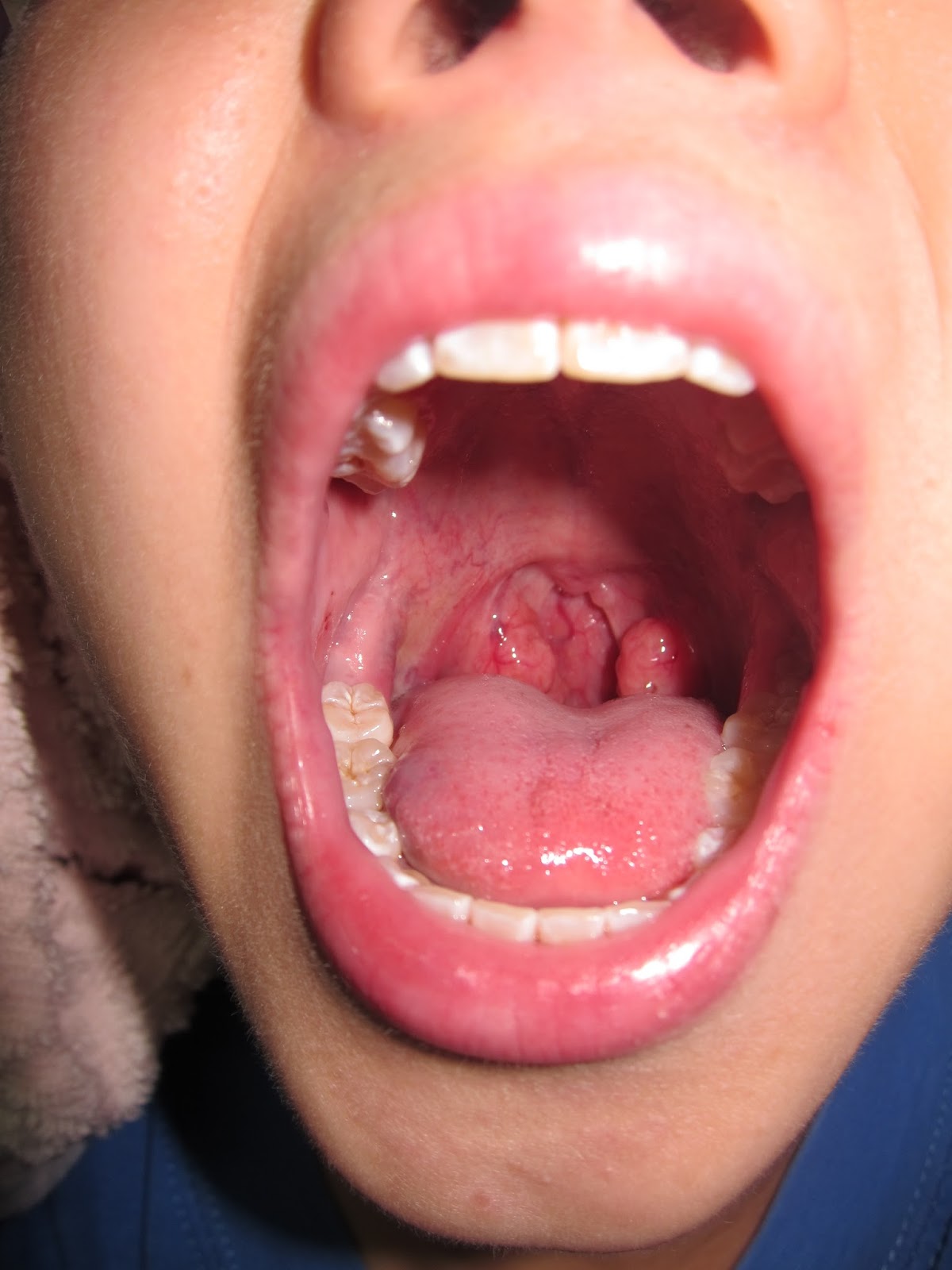 Removing Tonsil Stones With Toothpick