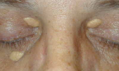 White Bumps Under Eyes - New Health Advisor