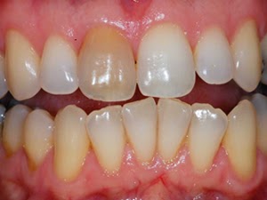 Tẩy trắng một chiếc răng đơn lẻ