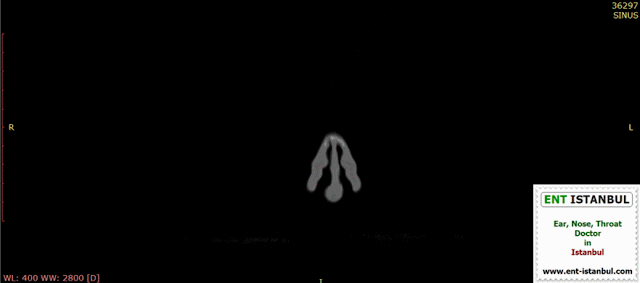 Computer Tomography Imaging Before The Septoplasty Operation - Paranasal sinus CT - Paranasal sinus computer tomography imaging