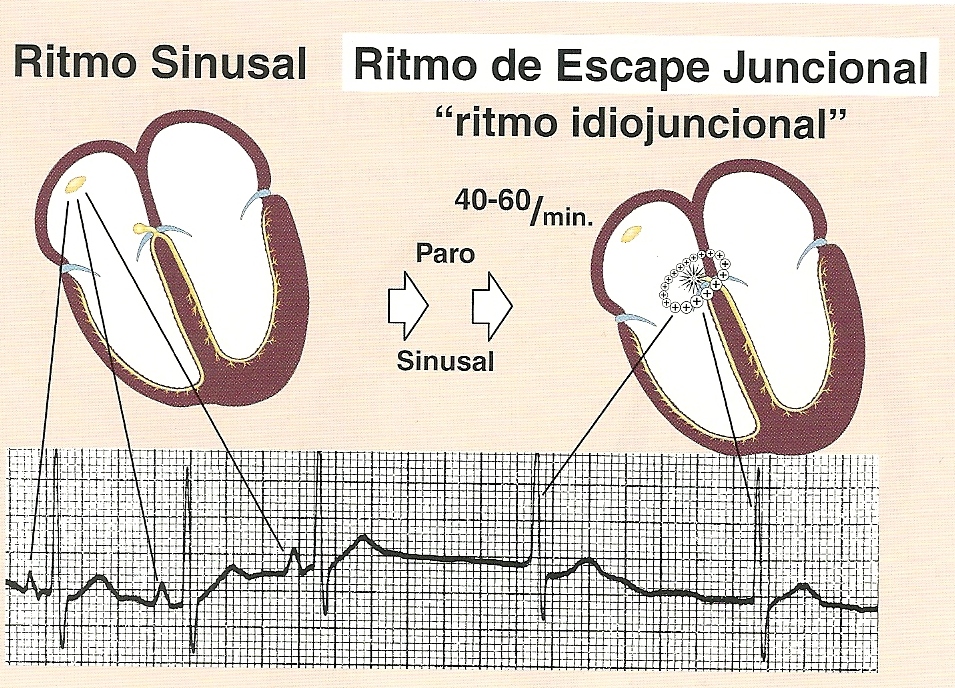 Electrocardiograma y Medicina General Ritmos de escape Electrocardiograma y Medicina General Ritmos de escape