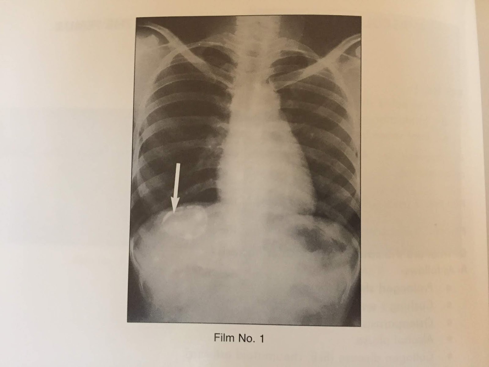 XRAYS HYDATID CYST OF THE LIVER