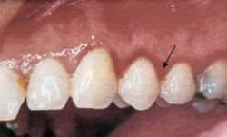 Is gum disease genetic? Periodontitis - Sharecare