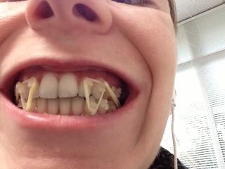 braces surgery elastics triangle lingual close orthodontic class openbite treatment
