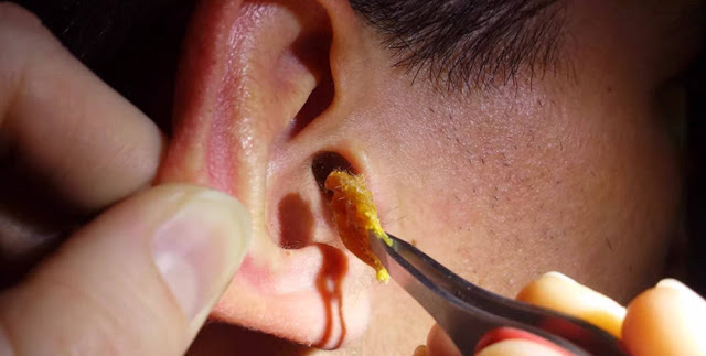 Best Way to Remove Ear Wax