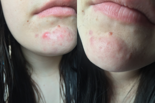 La Roche Posay Effaclar K (+ Before and After Images) 