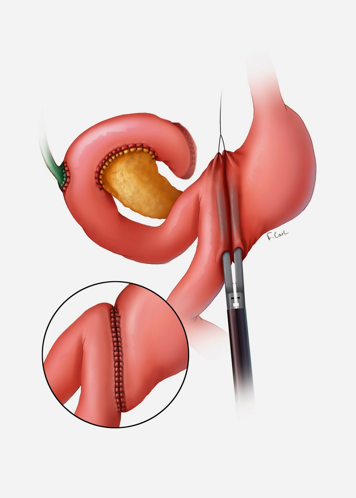 pancreas whipple procedure