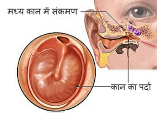 कान में संक्रमण, कान के पर्दे का इलाज, कान बहने का उपचार, कान में आवाज होना, कान के परदे का ऑपरेशन, कान का ऑपरेशन, कान का उपचार, कान की हड्डी, कान बहने की दवा