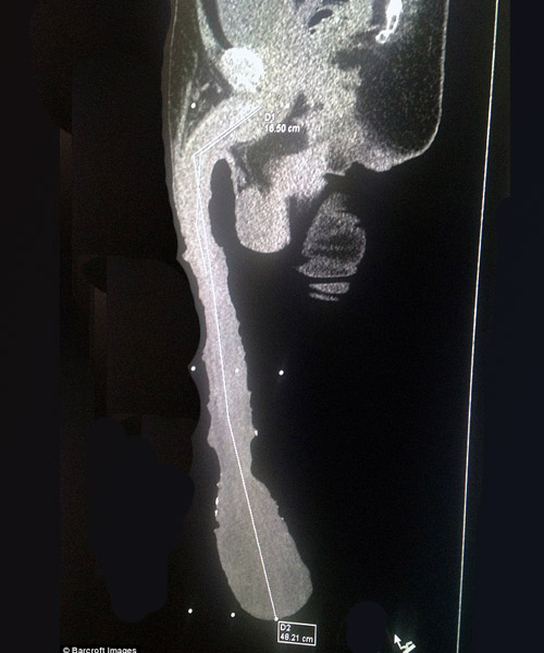 Lelaki Miliki Alat Sulit Terpanjang Di Dunia Enggan Pendekkan