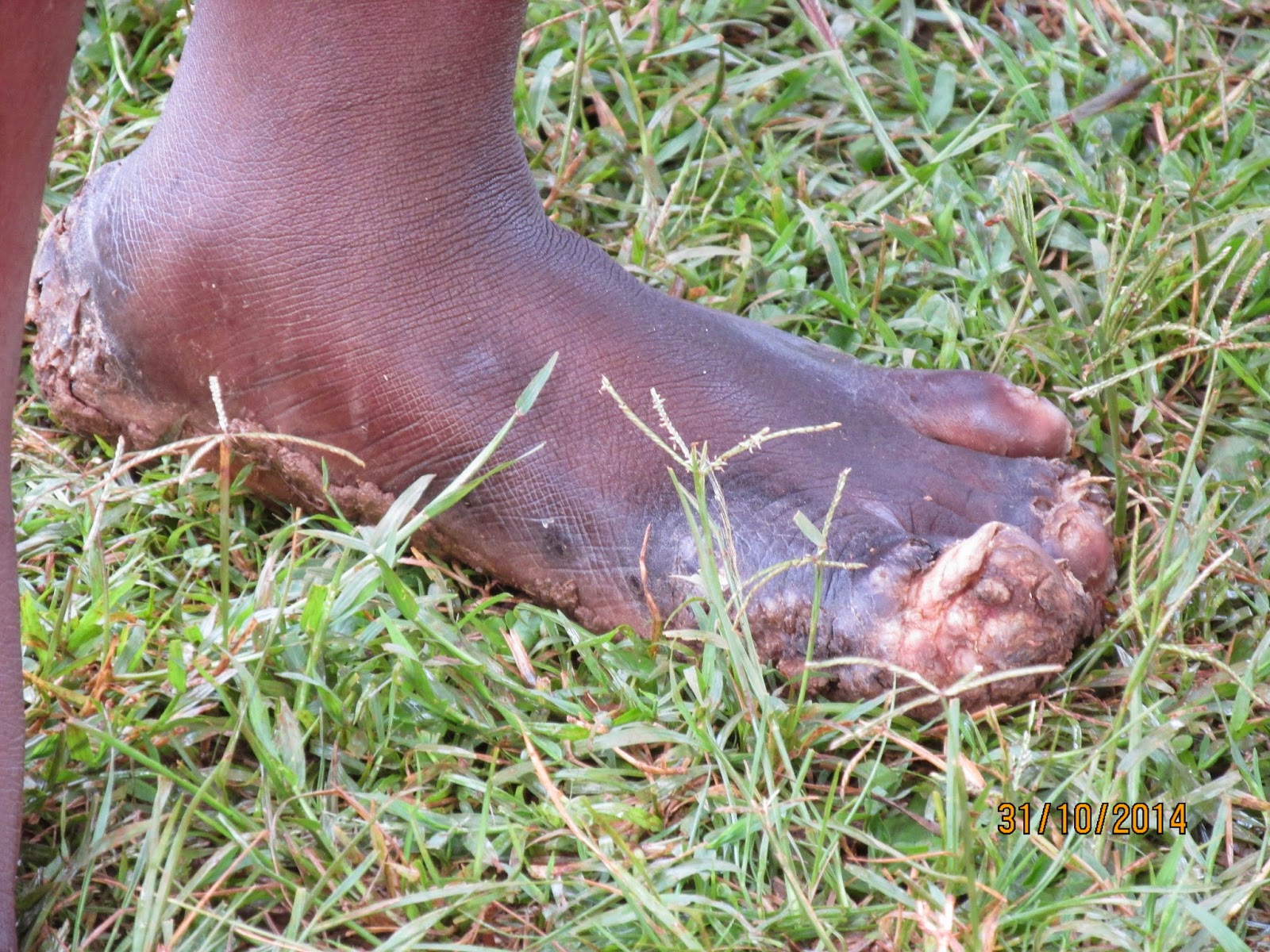 What Are Jiggers On Feet at Daniel Fowles blog