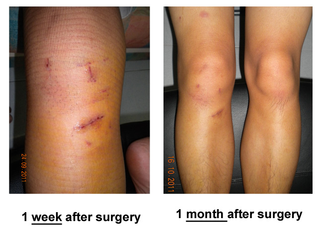 Twisted Knee Injury - ACL Reconstruction Surgery: November 2011