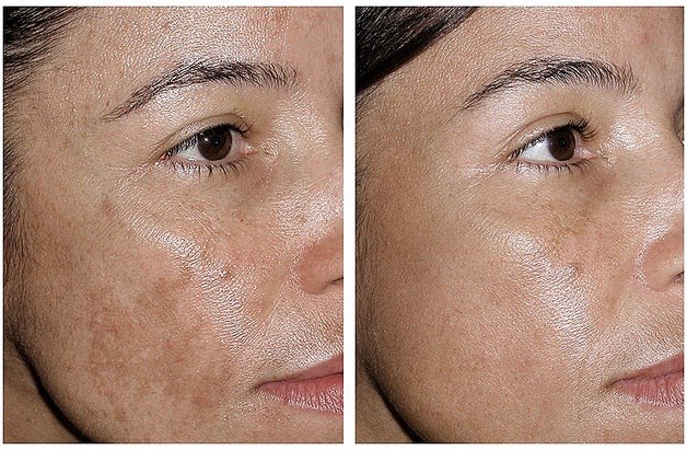 Hydroquinone Cream — The Dermatology Review