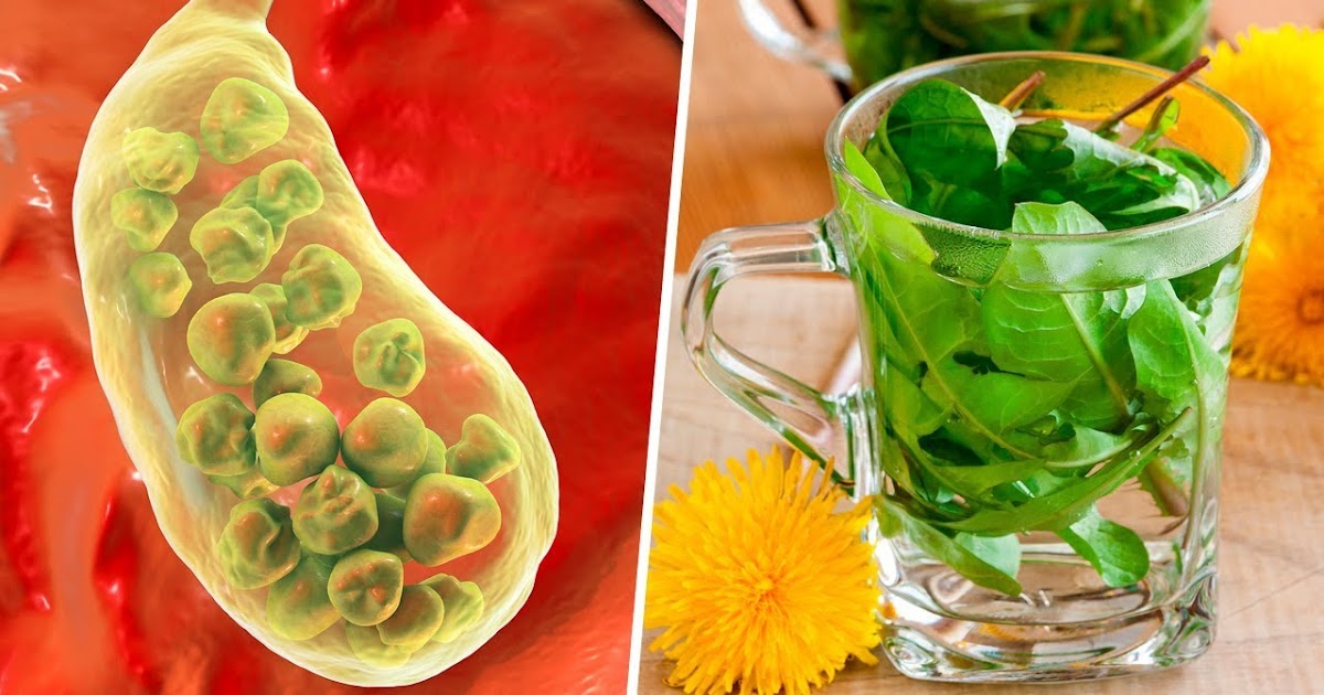 3 Ideal Allnatural Remedies for Gallstones