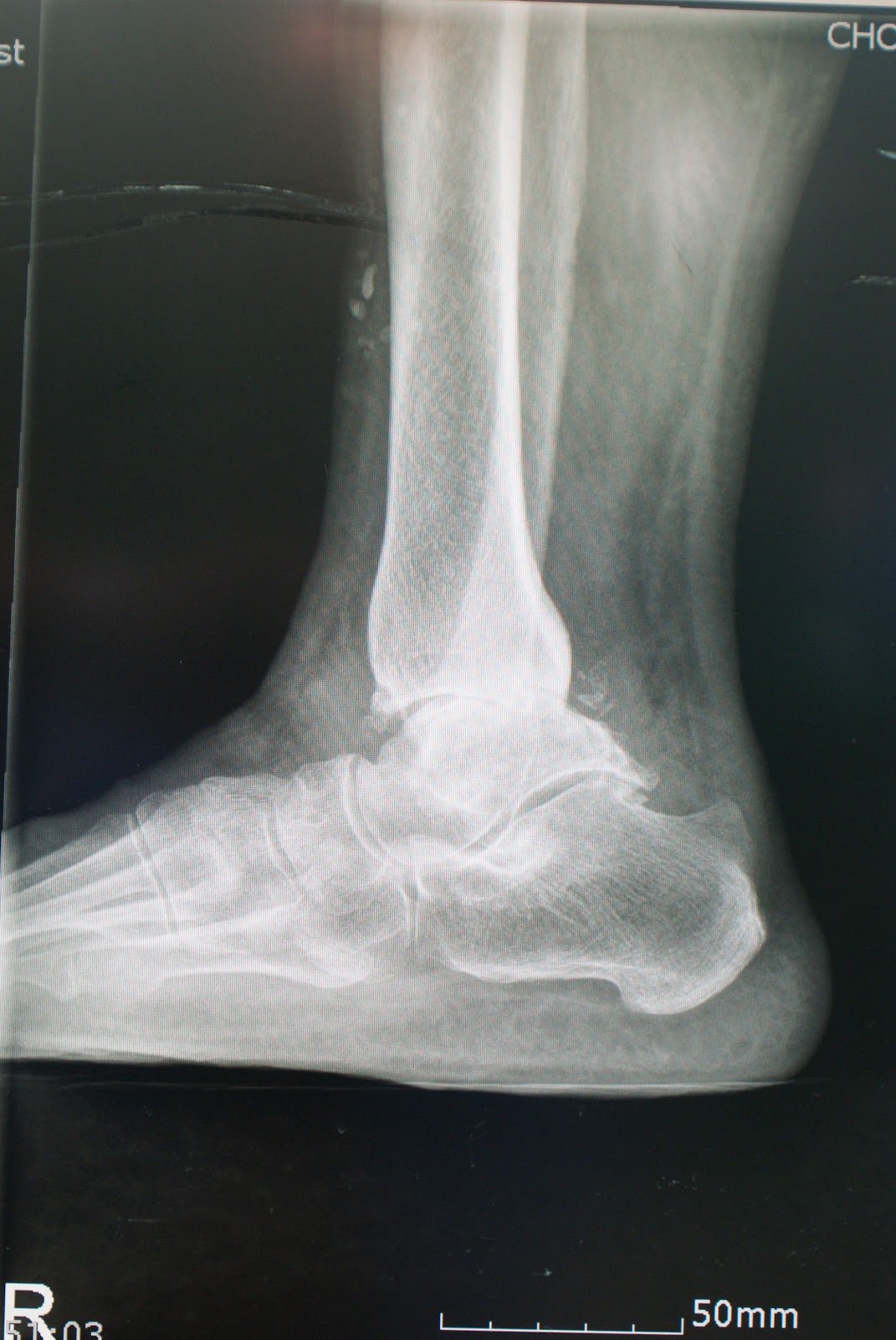 KUALA LUMPUR FOOT ANKLE CLINIC (KLFAC) ARTHRITIS OF THE ANKLE DR