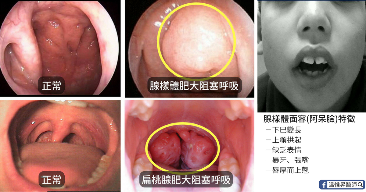腺 肥大 大人 扁桃