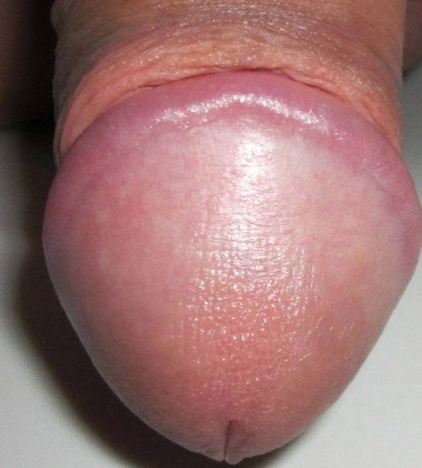 Healthy Penis Head 82