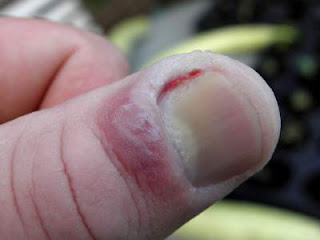 picture of thumb affected by chronic paronychia and Fungal (candidal) paronychia