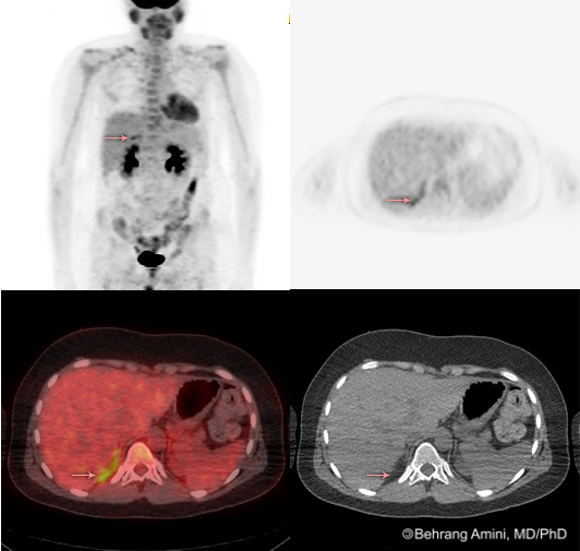 Roentgen Ray Reader: Infradiaphragmatic Brown Fat Uptake