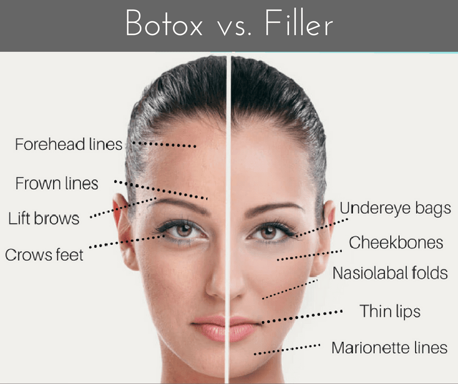 CARA MEMBUAT WAJAH JADI TIRUS DENGAN FILLER DAGU & BOTOX V SHAPE DI