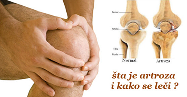 artroza ublažava bol u zglobovima