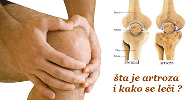 artroza zgloba koljena. simptomi. tretman)