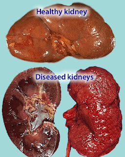 healthy-and-diseased-kidney