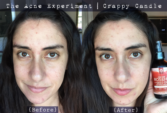 Before & After Rosehip Seed Oil :: The Acne Experiment