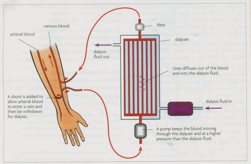 what-is-hemofiltration-with-pictures