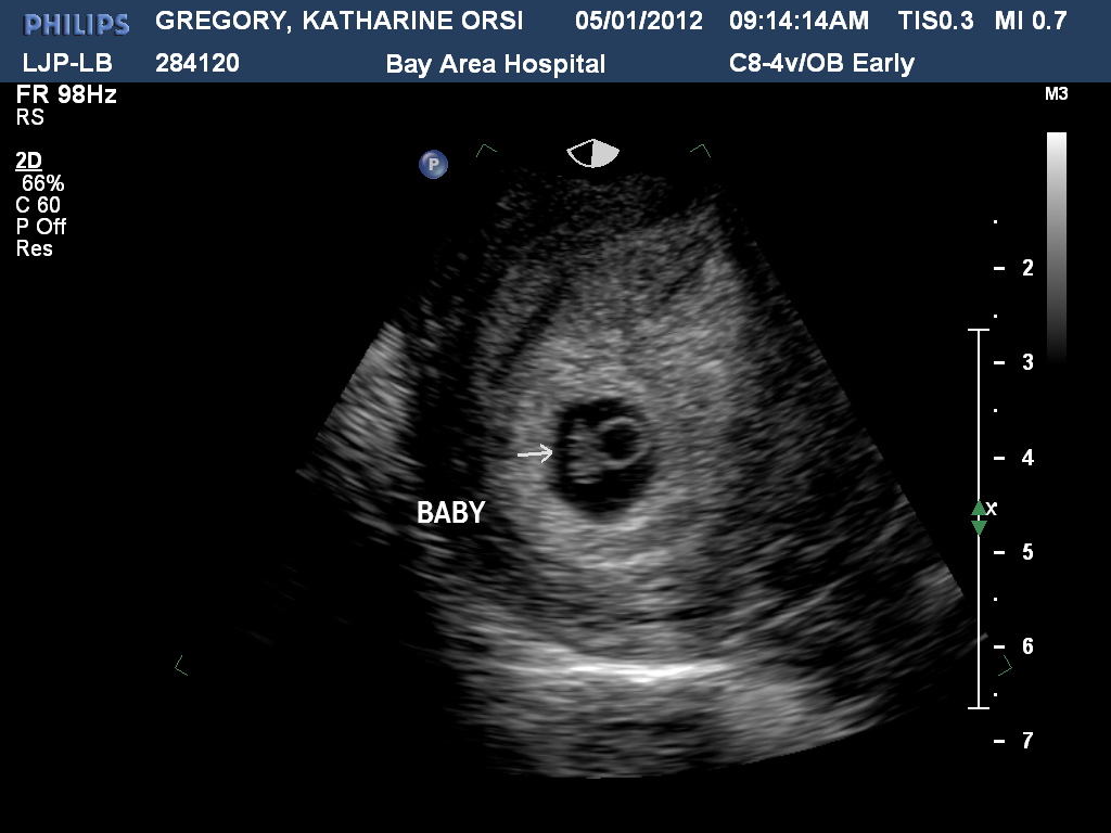 These Times My Ultrasound Today 7 3 Weeks 