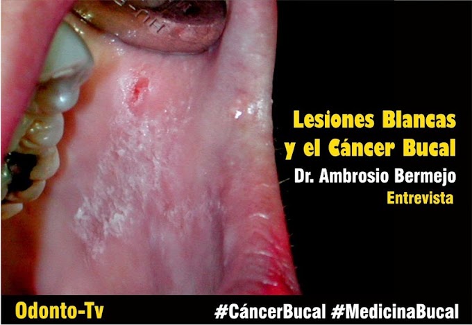 LESIONES ORALES: Lesiones blancas de la boca y su relación con el cáncer - Entrevista al Dr. Ambrosio Bermejo
