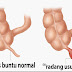 5 Macam Gejala Usus Buntu