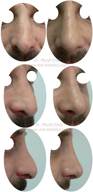 Revision nose aesthetic surgery - Secondary rhinoplasty - Revision nose job in Istanbul - Secondary nose job in Turkey - Secondary nose cosmetic surgery - Tertiary rhinoplasty - Secondary rhinoplasty challenges - Revision rhinoplasty using rib cartilage