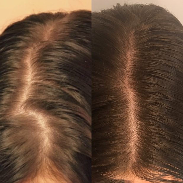 Telogen Effluvium & Hormonal Hair Loss/Thinning Update What Has Worked