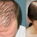 How to prevent hair loss naturally 