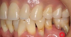 nagasima dental clinic: 左下奥歯のインプラントブリッジ症例