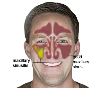 Pansinusitis: chronic maxillary sinusitis