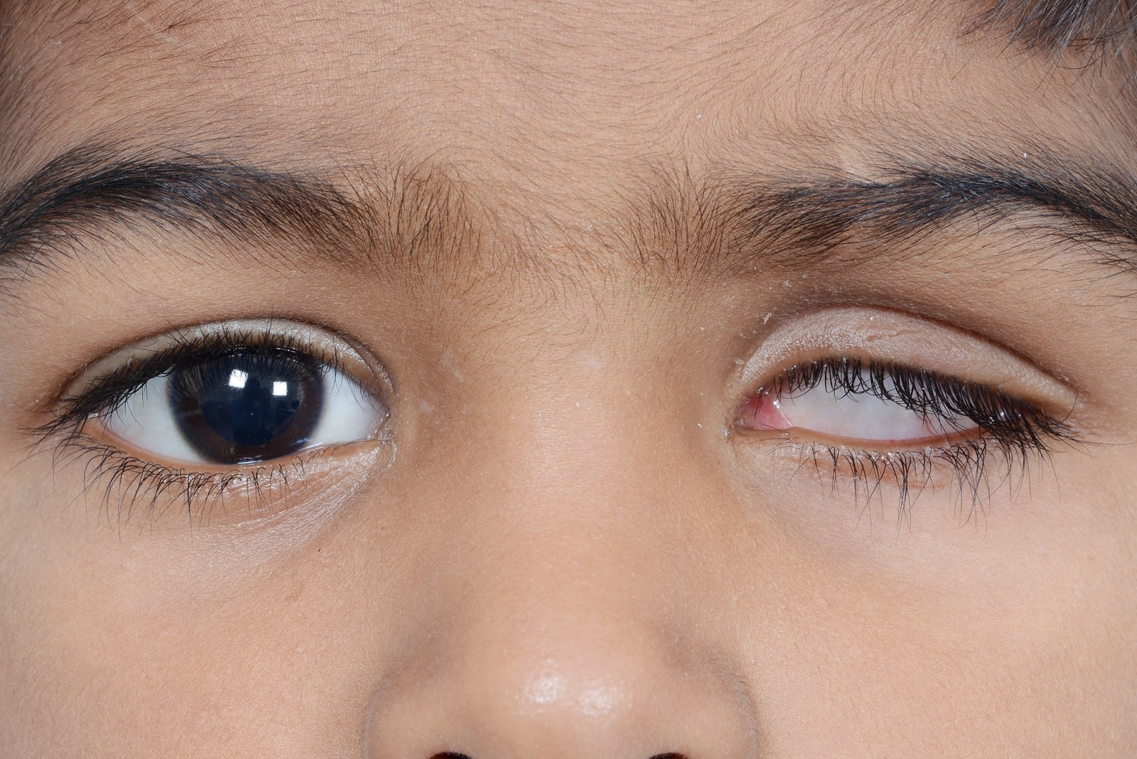 Best Ocular Prosthesis In India