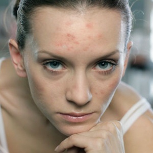comment traiter l'acné pendant la grossesse