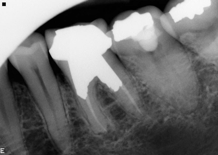 Boyd4Endo Case 44 root canal under crown